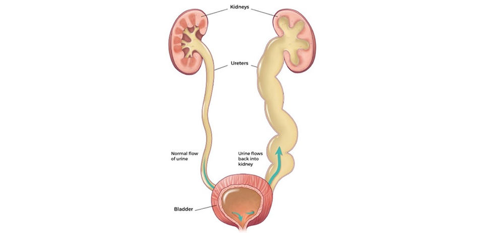 <p>Vesicoureteral Reflux (VUR)</p>