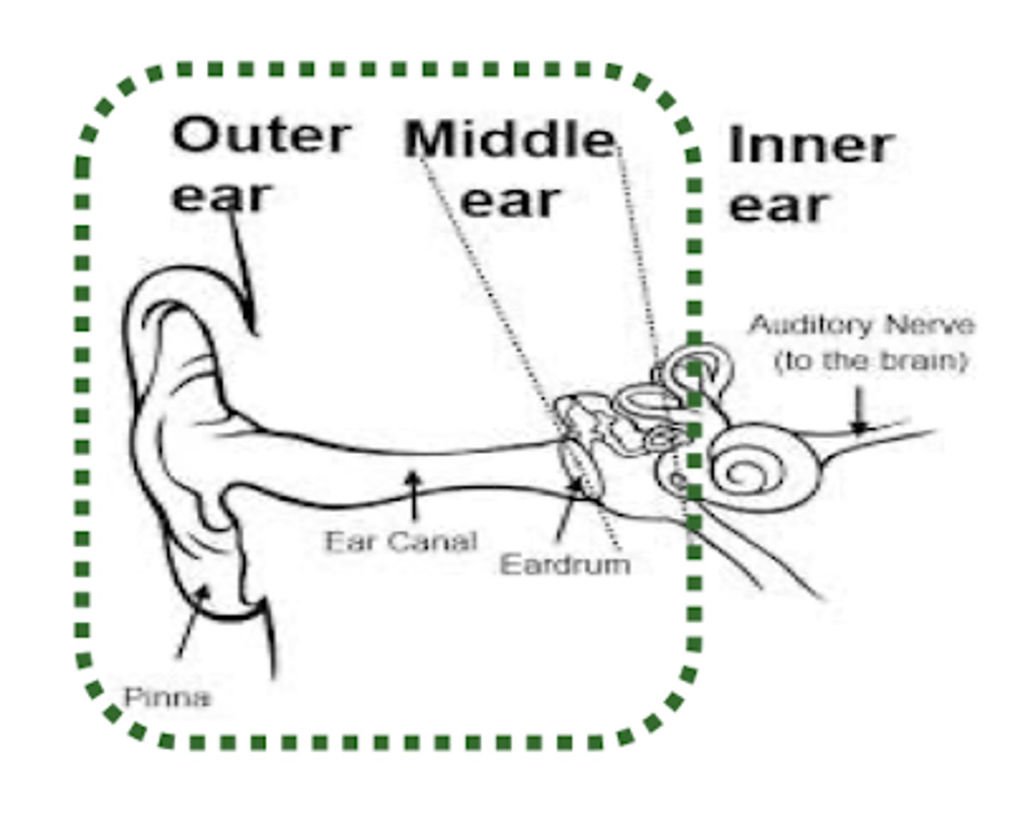 <p>Occurs when something in the outer ear or middle ear blocks or impedes the passage of sound waves ot the inner ear</p>