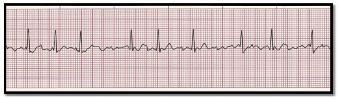 <p>What is the rhythm?</p>
