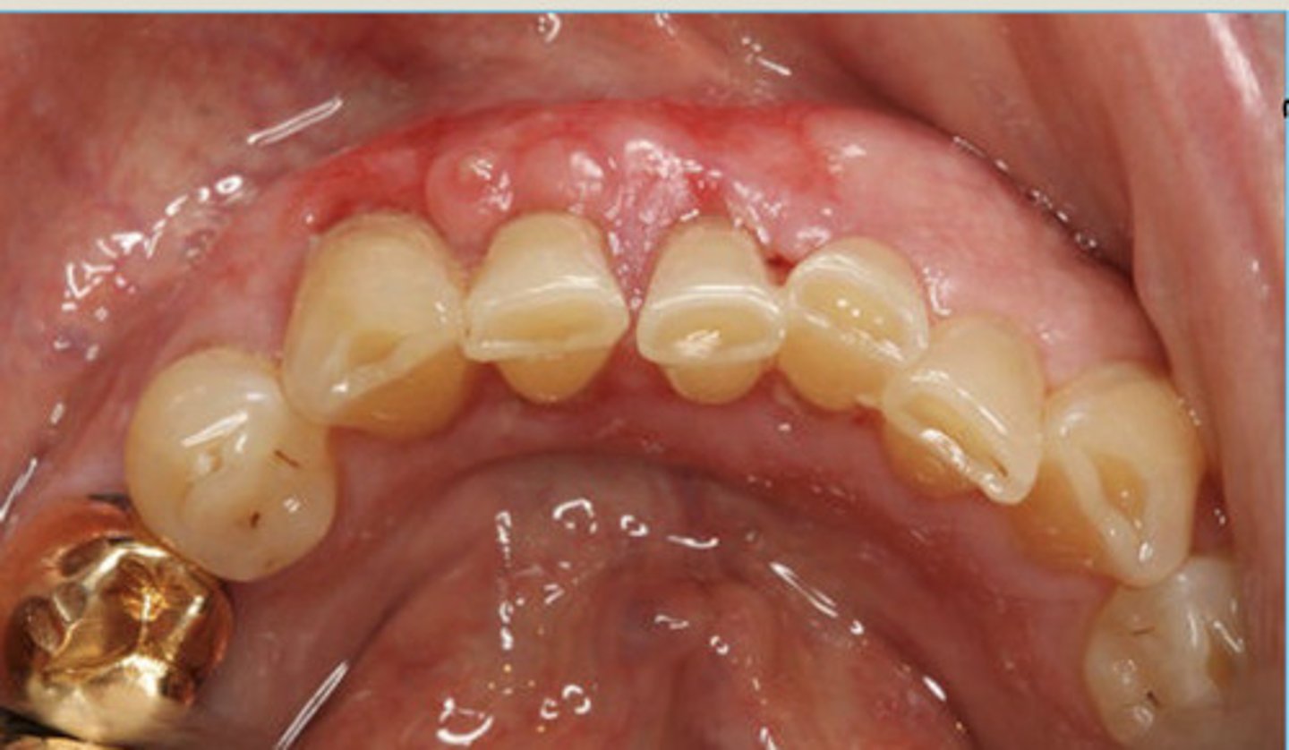 <p>irregular jaw path with history of cancer</p>