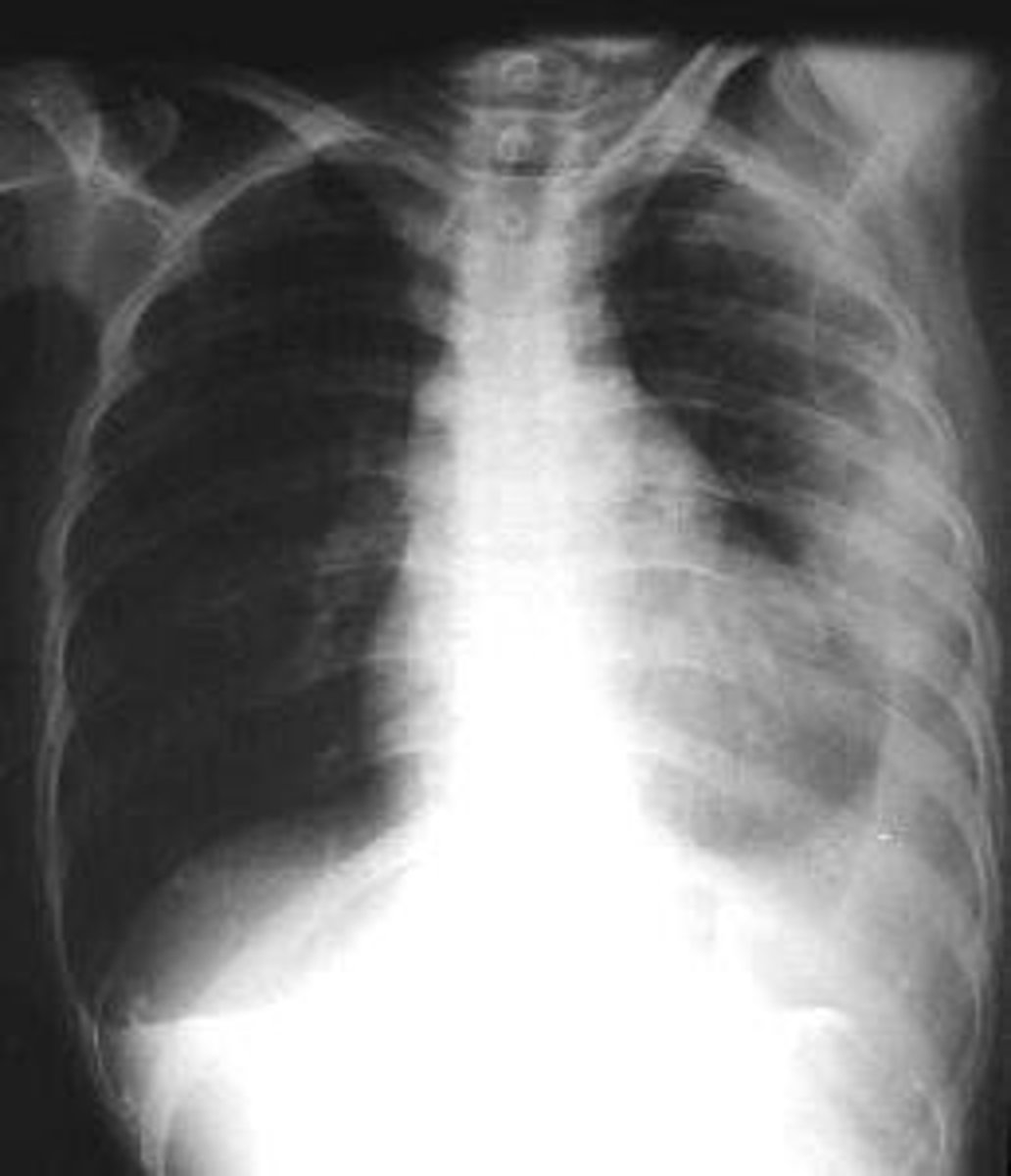 <p>blood in the pleural cavity</p>