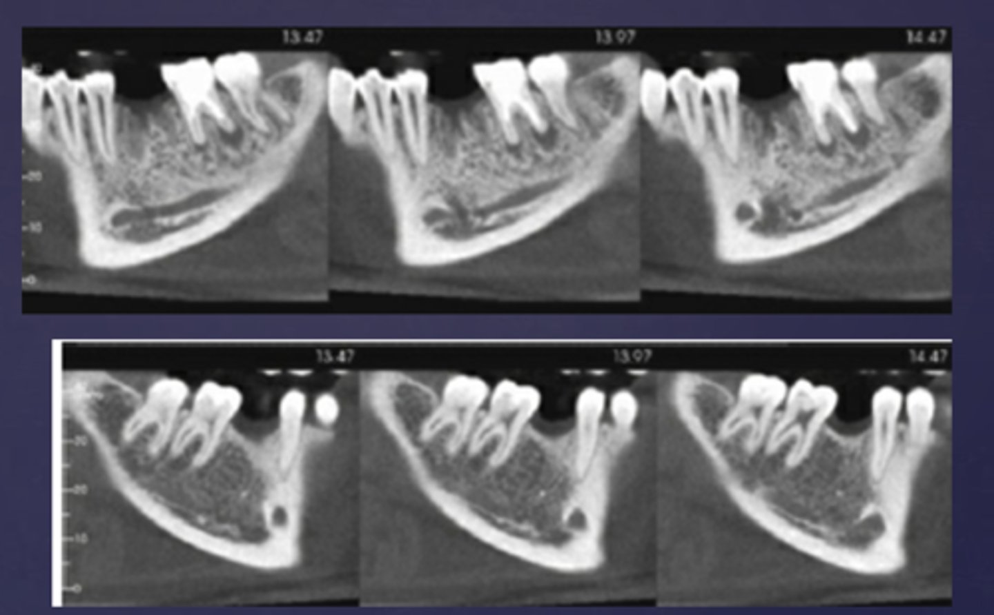 <p>What is bone deposition around area of rarefaction called?</p>