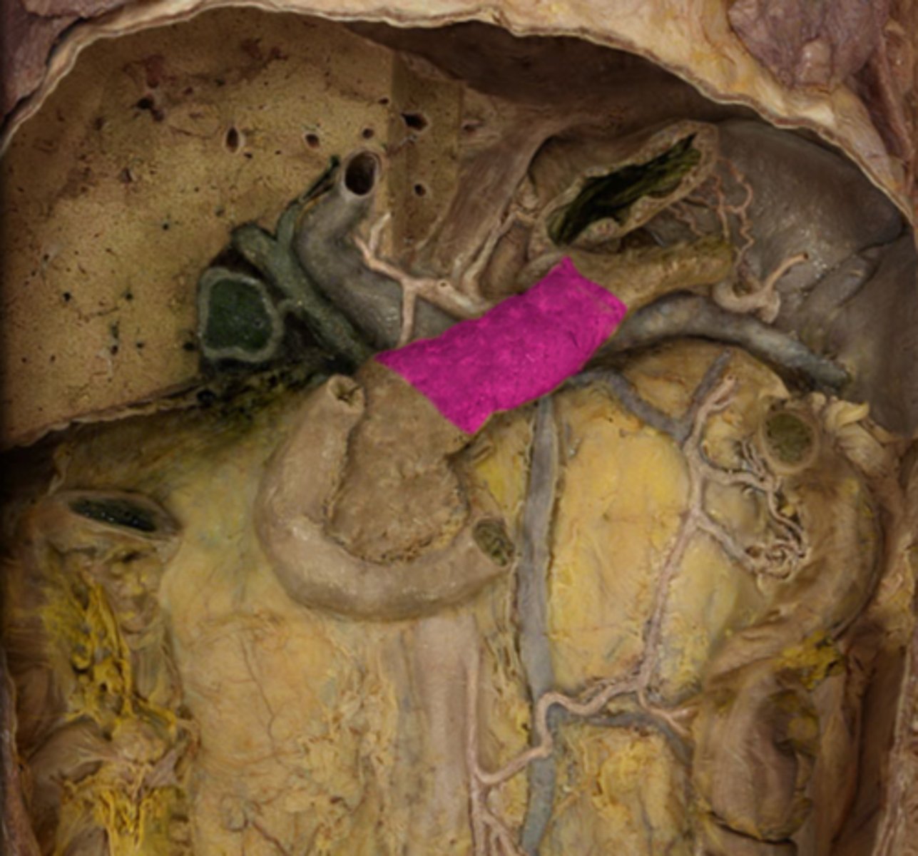 <p>What part of the pancreas is this?</p>