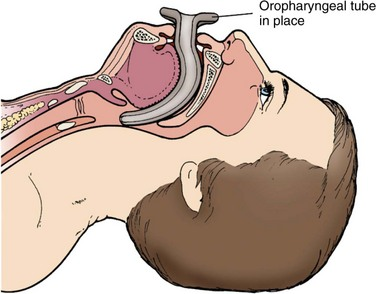 <p>Temporary airway adjunct - minutes to an hour</p>