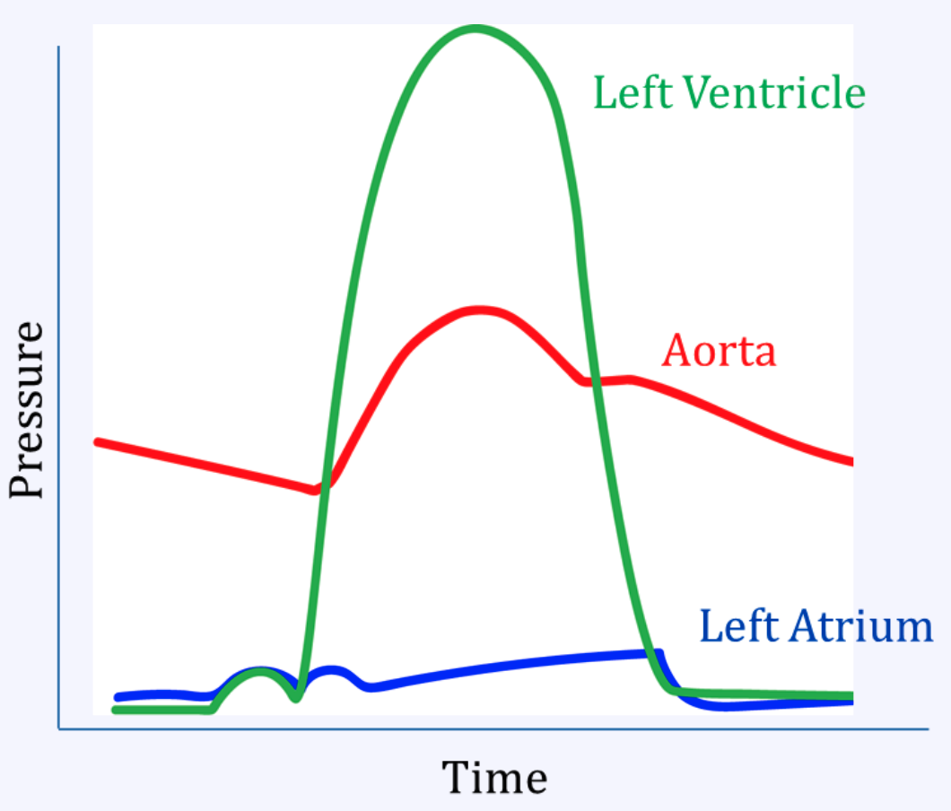 <p>Aortic stenosis</p>
