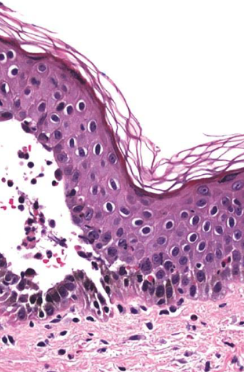 <p><span>immune system attacks desmosomes</span></p>