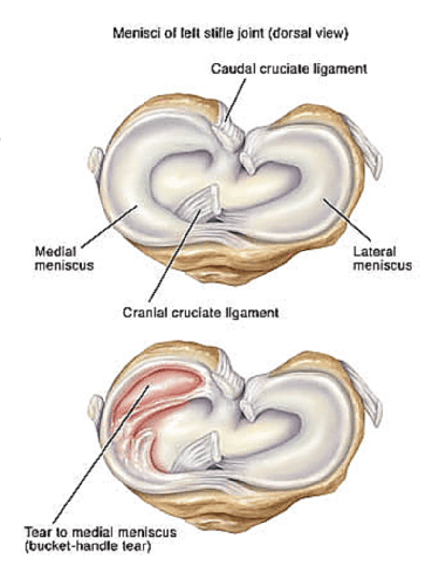 <p>meniscal injuries are often associated with ____</p>