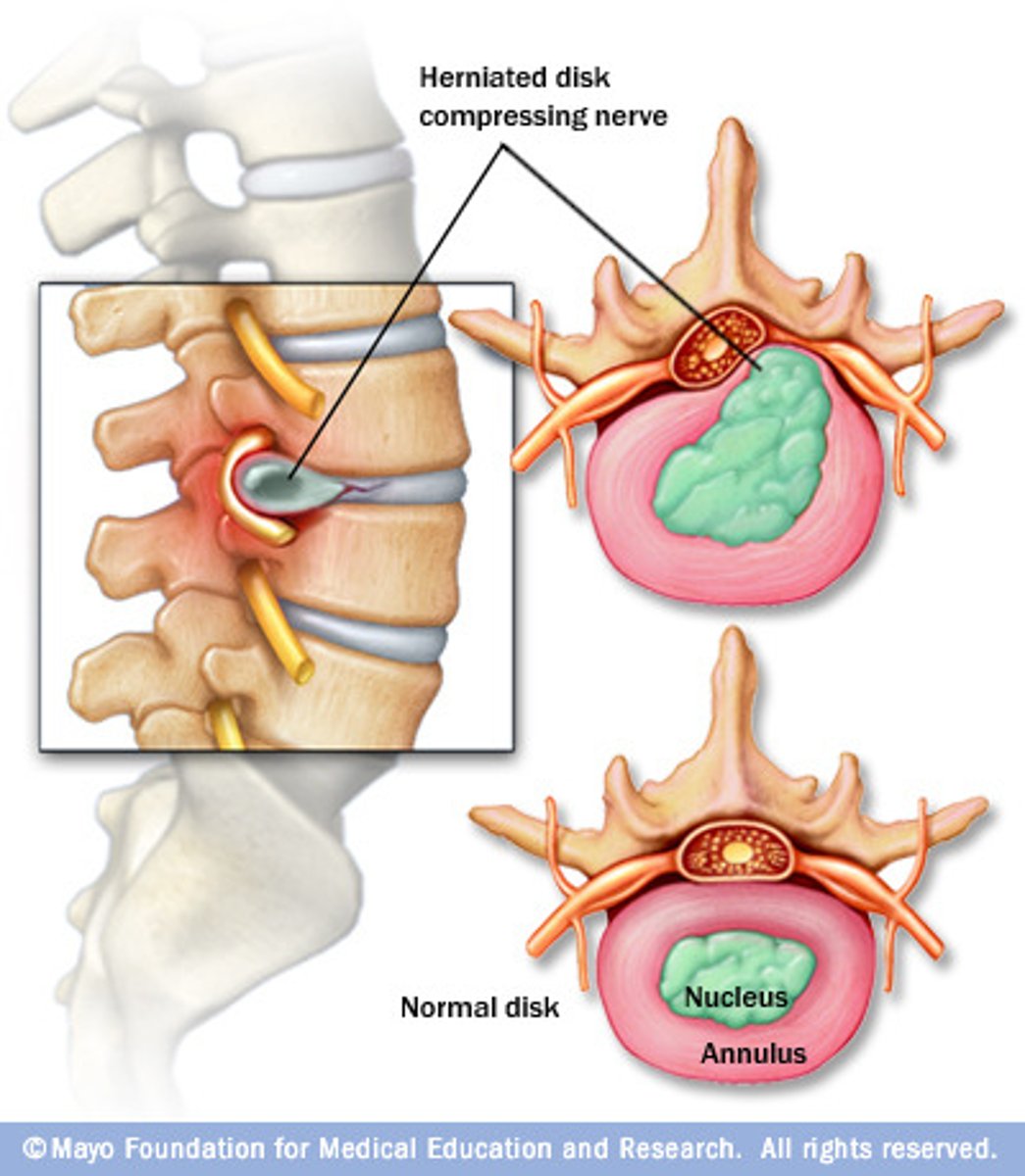 <p>Rupture of the soft tissue that separates two vertebral bones into the spinal canal</p>