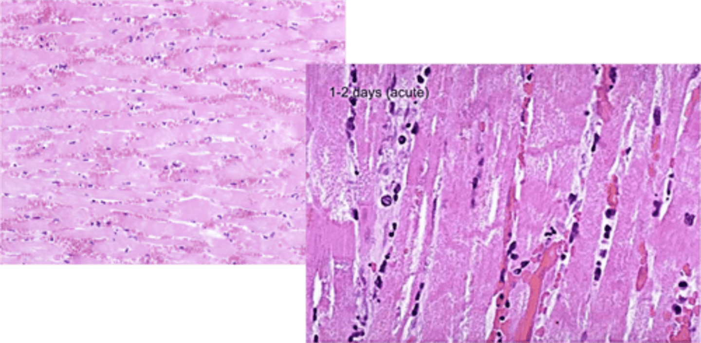 <p>Acute myocardial necrosis (12-24 hours) is characterized by what microscopically?</p>