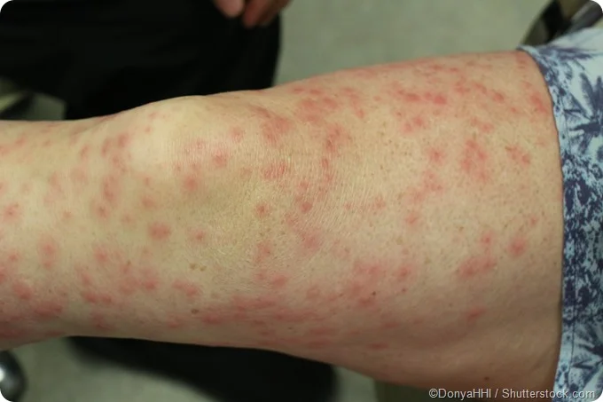 <p>Contact Dermatitis</p>