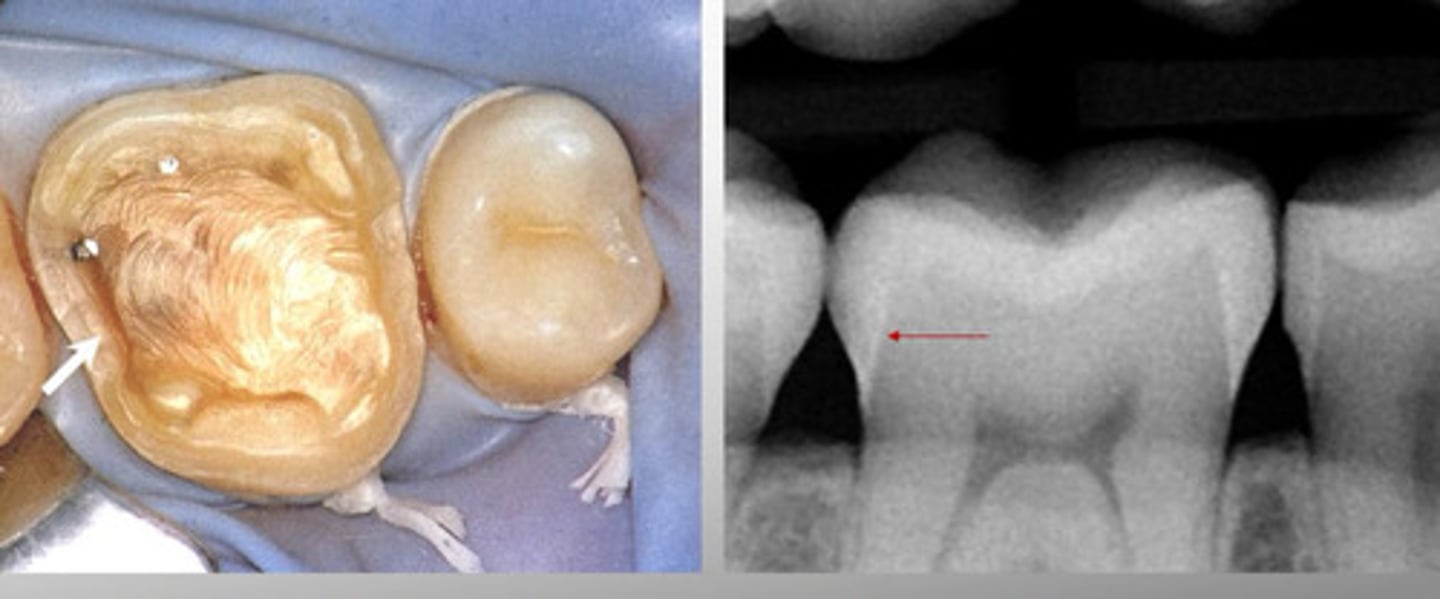 <p>Inner surface of enamel cap visible in cross section or badly worn teeth</p>