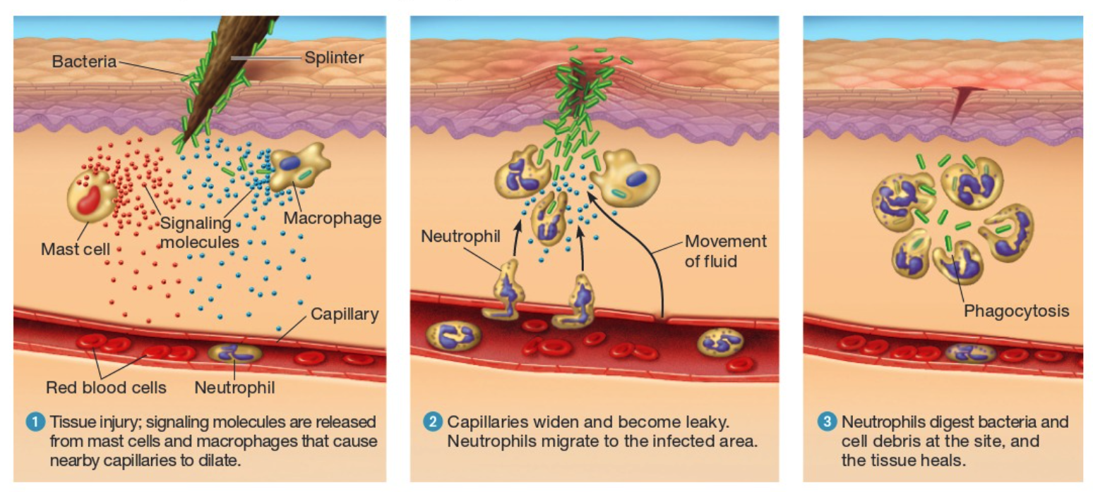 <ul><li><p>Purpose: to disinfect and clean injured tissues</p></li><li><p>Step 1 → Tissue injury; signaling molecules are released from mast cells and macrophages that cause nearby capillaries to dilate (goal to get more blood)</p><ul><li><p><em>The presence of bacteria causes the activation of two types of white blood cells</em></p></li><li><p>macrophages produce signaling molecules → bring fluid to the infecred area (more blood flow to the area)</p></li><li><p><strong>mast cells </strong>→&nbsp;release histamines that cause blood capillary dialation (widens) → larger diameter needed for more blood + capillaries become leaky</p></li></ul></li><li><p>Step 2 → Materials are released from the blood through the widened and leaky vessels</p><ul><li><p><em>Materials (below) are released from the blood through the widenend and leaky vessels</em></p></li><li><p><strong>plasma </strong>→ fluid in blood</p></li><li><p><strong>clotting proteins </strong>→ aid in clotting</p></li><li><p><strong>platelets</strong> → makes clot; cell fragments</p></li><li><p>activated complement proteins attract phagocytes from blood (nuetrophils)</p></li><li><p><em>Results in swelling, warmth, and redness</em></p></li></ul></li><li><p>Step 3 →&nbsp;Bacteria are englufed by nuetrophils</p><ul><li><p><strong>pus</strong> → dead cell debris</p></li><li><p>Nuetrophils eventually die or are destroyed</p></li></ul></li></ul><p></p>
