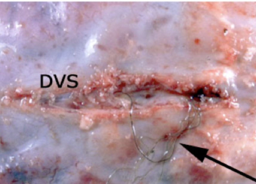 <p>Which parasite is seen in this image (arrow pointing at worm)? DVS = dorsal venous sinus. </p>