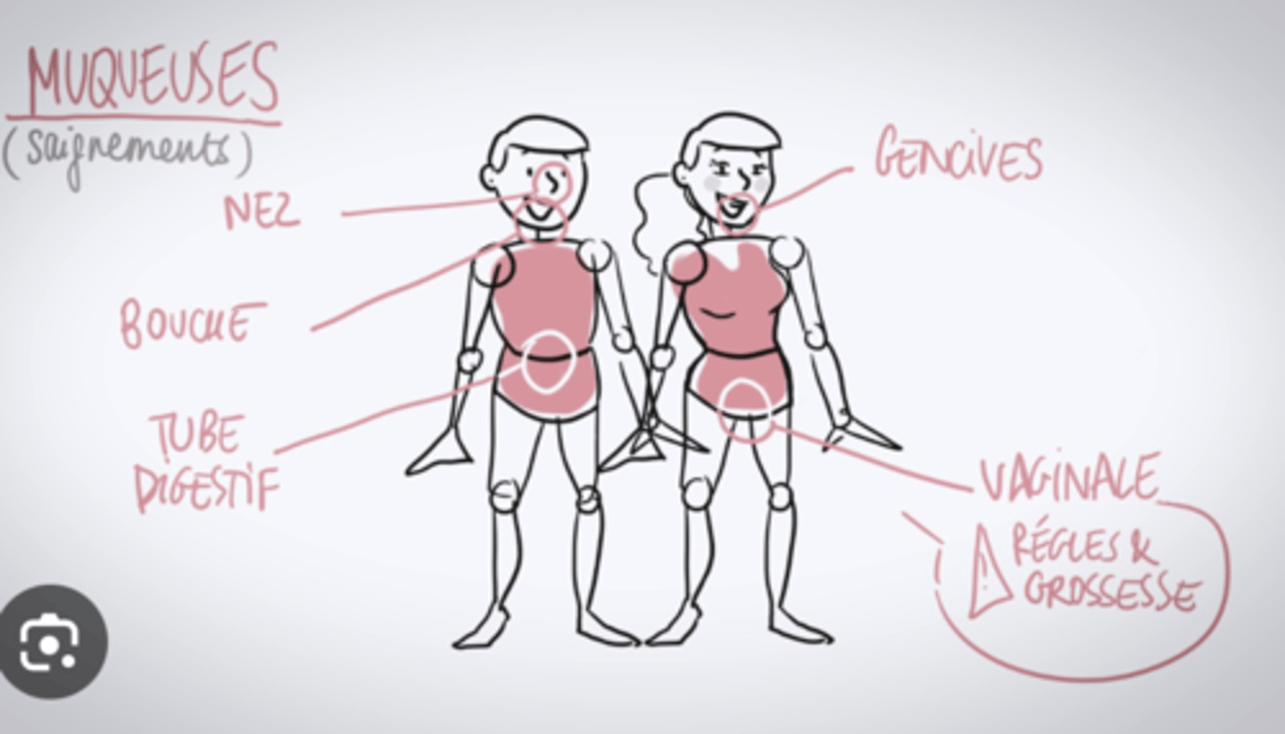 <p>Syndrome hémorragique cutanéo-muqueux : </p><p>Ecchymoses, épistaxis, gingivorragies, </p><p>ménorragies, métrorragies, </p><p>saignement digestif, </p><p>hémorragie du post-partum</p>
