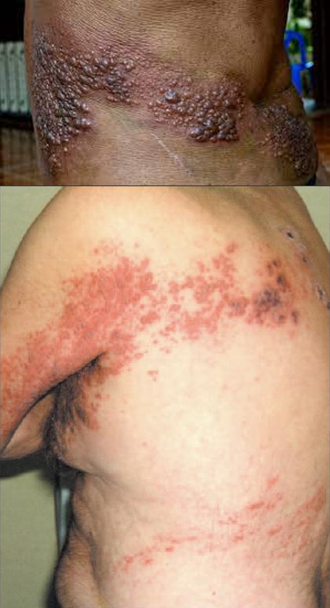 <p>Because the rash <strong>wraps around the body</strong> in a band-like pattern, especially in the <strong>thoracic region</strong>, where it follows the path of the infected nerve.</p>
