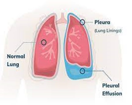 <p>Pleural Effusion</p>