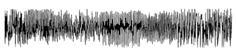 <p>Very high frequency of the EEG, the brain is overactive. </p>
