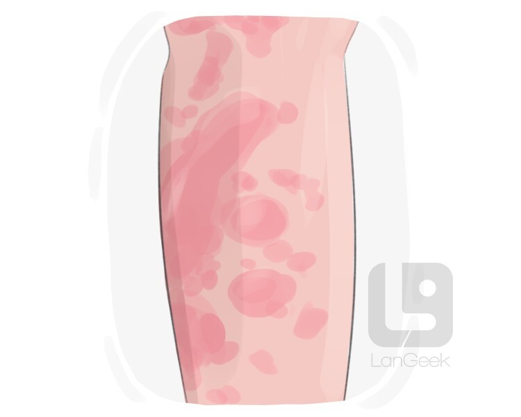 <p><span style="background-color: transparent;"><span>sarpullido, imprudente</span></span></p>