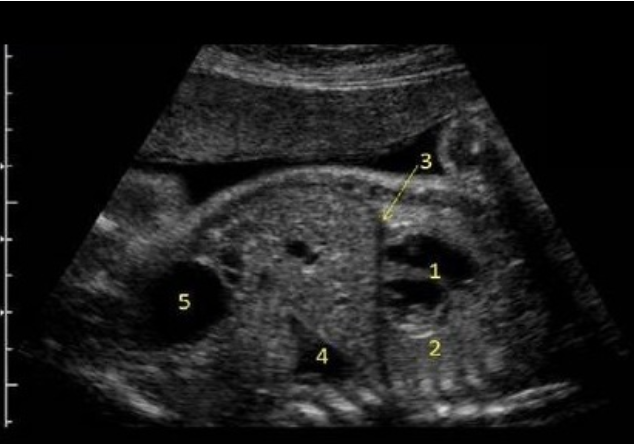<p>what is #2</p><p>a) diaphragm</p><p>b) lung</p><p>c) liver</p><p>d) thymus</p>
