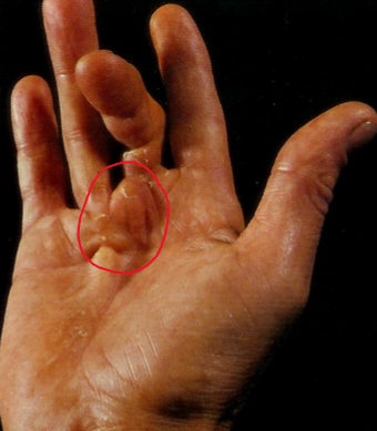 <p><strong>benign superficial proliferations of fibrous tissue </strong></p><ul><li><p>make be <strong><mark data-color="blue">palmar, plantar, or penile</mark></strong></p><ul><li><p><strong><span style="color: red">palmer = Dupuytren's contracture (digit 4 &amp; 5)</span></strong></p></li><li><p><strong><span style="color: purple">penile = Peyronie’s disease (may constrict urethra &amp; cause painful erections)</span></strong></p></li></ul></li></ul>