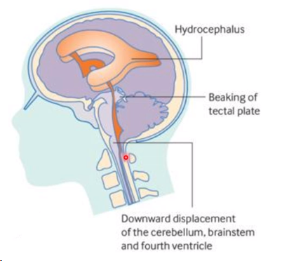 <p><span>Chiari II (downward herniation of the cerebellum through the foramen magnum)</span></p><p><span>Hydrocephalus (enlargement of the ventricles of the brain)</span></p>