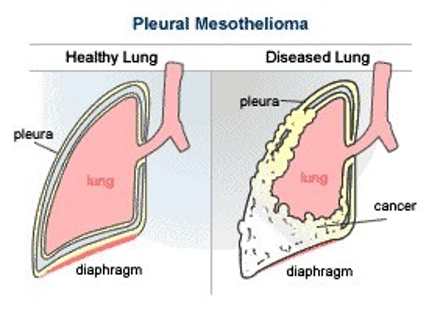 <p>Cancer that arises from the mesothelial cells of the pleura is caused by asbestos fibers</p>