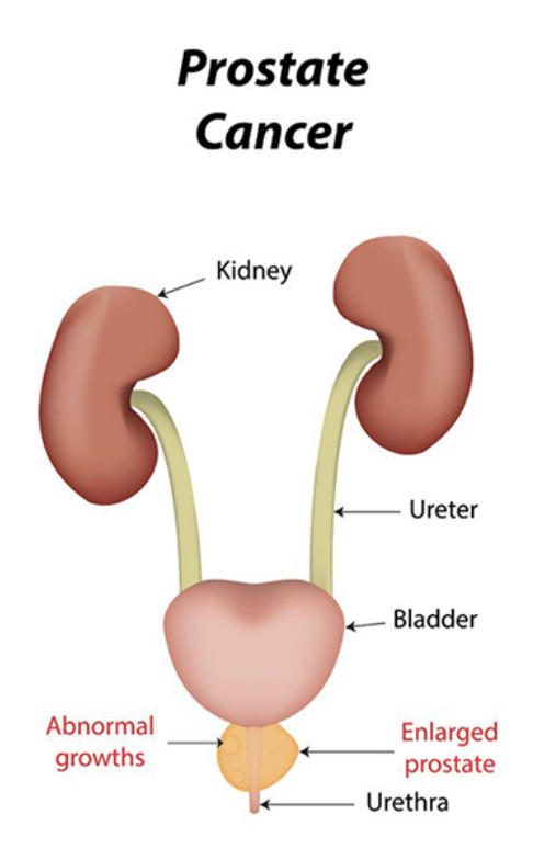 <p><strong><span>PROSTATE CANCER</span></strong></p><ul><li><p><strong><span>Most common </span></strong><span>malignant tumour in men over 65 years</span></p></li><li><p><span>At age 50 to 65, 15-20% have histological evidence rising to 50% at age 80</span></p></li><li><p><span>Most of these are tiny and may have remained latent for many years</span></p></li><li><p><strong><span>Often metastasises </span></strong><span>to pelvic bone via lymphatic's and blood supply</span></p><p><strong><span>Risk factors</span></strong><span>:</span></p></li></ul><p><span>- Age: rare &lt;40, 29% 6th decade, 67% 9th decade o Hereditary: Risk doubled with 1st degree relative</span></p><p><span>and x4 if 2 FDR<br>- Race: lower incidence of clinically evident disease</span></p><p><span>in Japan and China<br>-  Diet: High saturated fat increased risk</span></p>