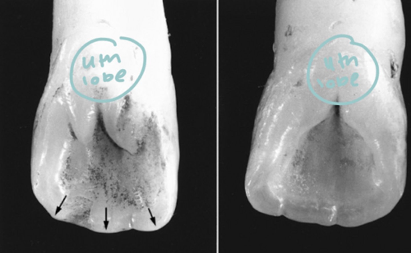 <p>The cingulum forms the 4 developmental lobe</p>