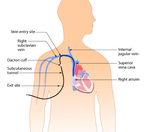<p>what catheter type is shown in this image (be specific)</p>