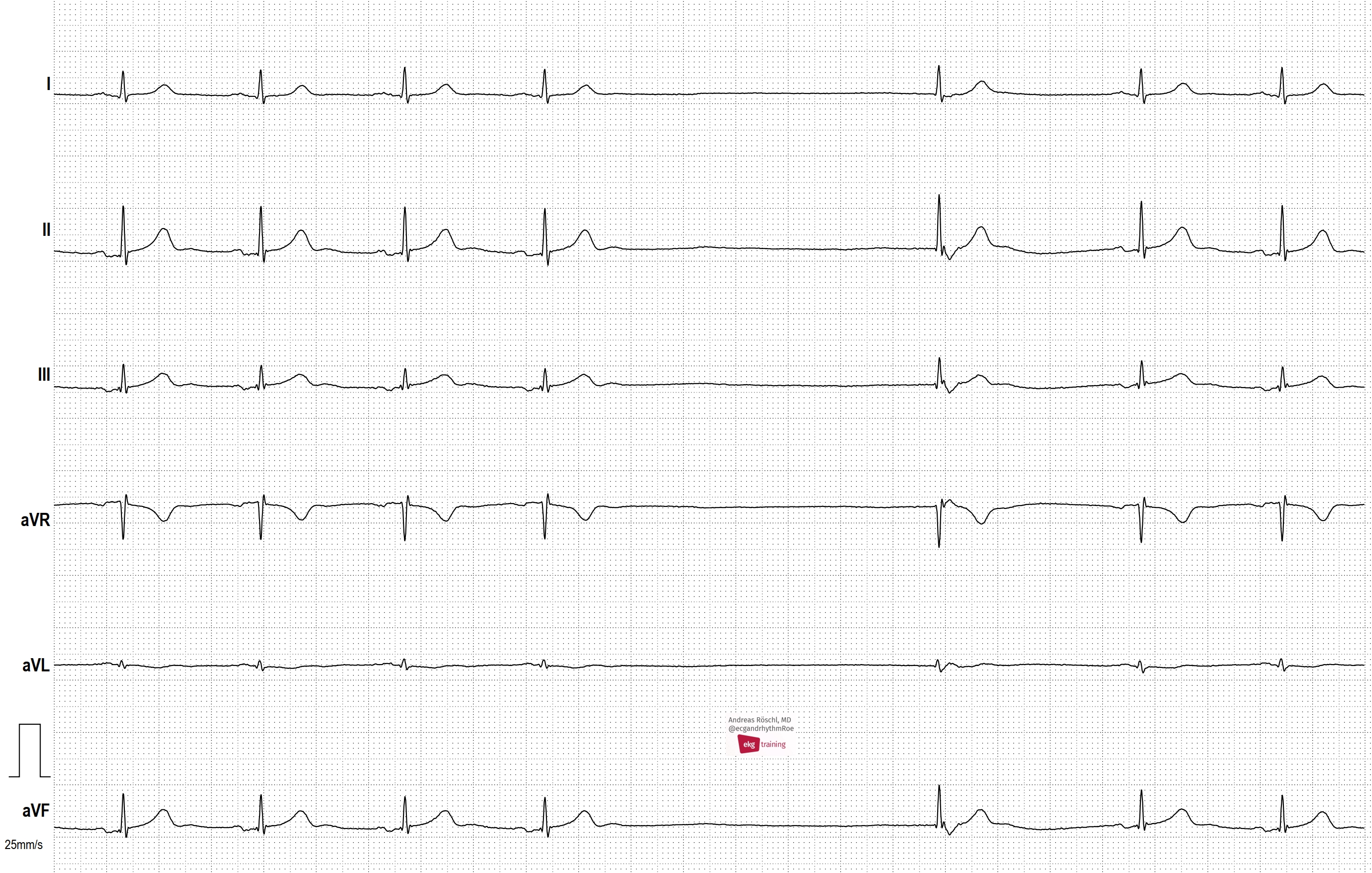 <p>Describe the rhythm of this patient.</p>