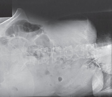 <ul><li><p>structures shown:</p><ul><li><p>air or fluid levels</p></li><li><p>right border of the abdominal region must be visualized</p></li></ul></li><li><p>evaluation criteria:</p><ul><li><p>no motion</p></li><li><p>well-defined diaphragm and abdominal viscera</p></li><li><p>air or fluid levels</p></li><li><p>right and elft abdominal wall and flank structures</p></li><li><p>no rotation </p><ul><li><p>symmetric appearance of vertebral column and iliac wings</p></li></ul></li></ul></li></ul><p></p>