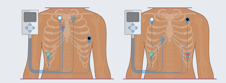 <p>white: right sternal border, first rib</p><p>red: left sternal border, third rib</p><p>black: left side, anterior axillary line, fifth rib</p><p>brown: left sternal border, first rib directly opposite the white lead</p><p>green: right lower thoracic area anywhere on ribcage</p><p></p><p>or</p><p></p><p>white: right chest, about 2in below clavicle</p><p>red: left chest, lower rib cage area</p><p>black: left chest, opposite of white lead</p><p>brown: right chest, fourth rib</p><p>green: right lower chest, over a rib</p>