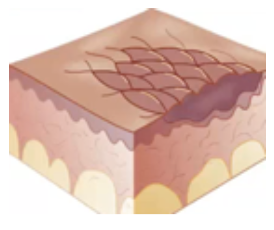 <p>Secondary Skin Lesion</p><ul><li><p><strong>Degeneration</strong> of skin</p></li><li><p>Loss of <strong>elasticity</strong> and <strong>texture</strong> brought about by <strong>friction</strong> (e.g., contact dermatitis)</p></li></ul><p></p>