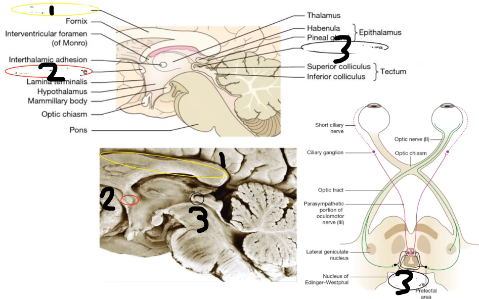 <p>comissural bundles: 1 is ______ ______, 2 is ______ _____ and its function is nto really known, 3 is ____ _____ and coordinates pupillary light reflex via bilateral input to Edinger Westphal nucleus, pretectal nuclei are inside it </p>