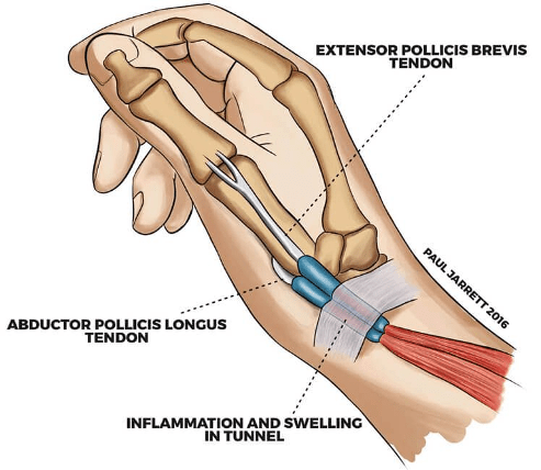 <p>-Inflammation of extensor pollicis brevis (EPB) and abductor pollicis longus (APL) tendons at 1st dorsal compartment</p><p>-Pain at anatomical snuffbox, swelling, decreased grip/pinch strength</p><p>-Positive Finkelstein’s test</p><p>-Common in pregnancy</p>