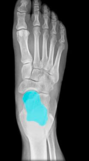 forms ankle joint btwn foot and leg
allows for plantar flexion and dorsiflexion