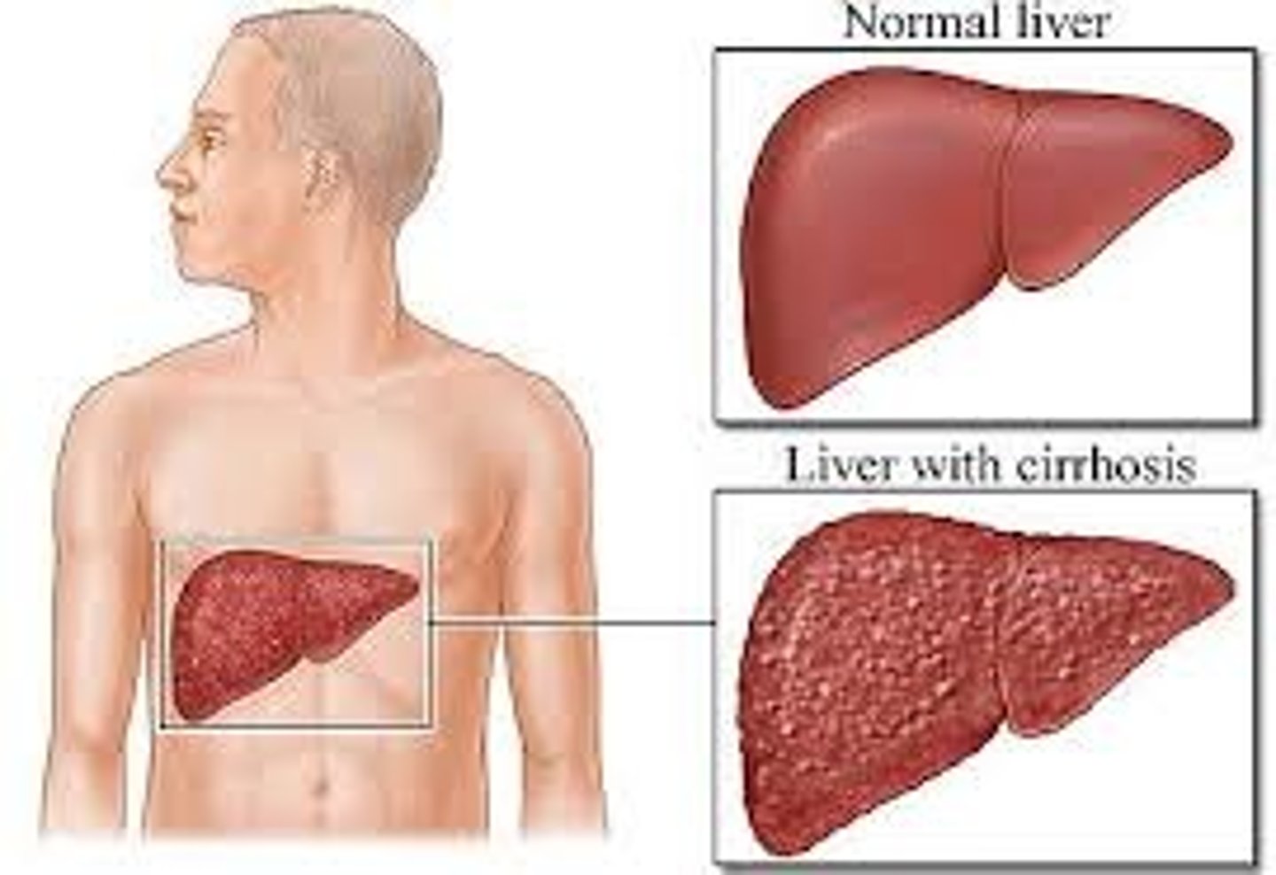 <p>chronic degenerative disease of the liver</p><p>enlarged and nontender</p>