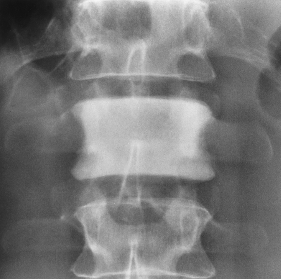 <p>skeletal appearance of lymphoma&nbsp;</p>