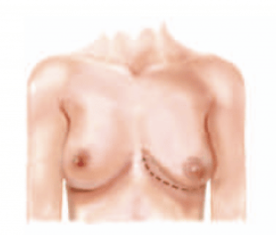 <p>Underdevelopment of lower medial quadrant of breast </p>