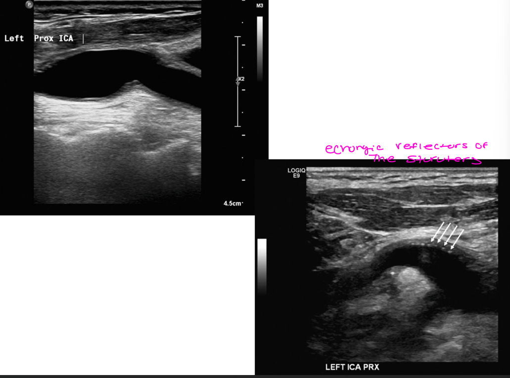 <p>Sonographic appearance</p><p> Absent intima / media stripe</p><p> Sutures can appear as echogenic</p><p>reflector</p><p> Wall thickening can occur</p><p> Intimal hyperplasia</p><p> Re-stenosis can occur</p><p> Doppler appearance</p><p> Color – disturbed/flow</p><p>separation</p><p> Spectral – low velocity, disturbed</p><p>waveform</p>