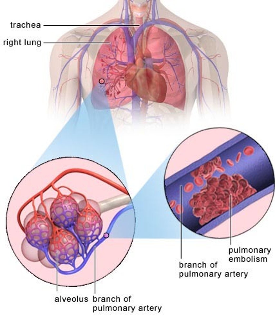 <p>-usually caused by a thrombus from the lower legs that moves up to the lungs (blood clot is most common)</p><p>-can also be caused fat (from bone marrow especially following femur fracture) or air or a foreign body</p>
