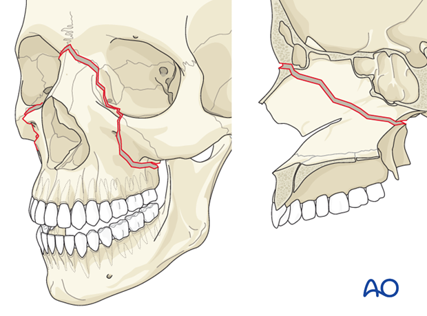 <p>a fracture line from one of the lateral vertical buttresses across the maxillary bone, extending into the inferior orbital rim and crossing the midline</p>