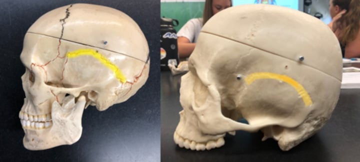 <p>Separates other bones from temporal bones</p>