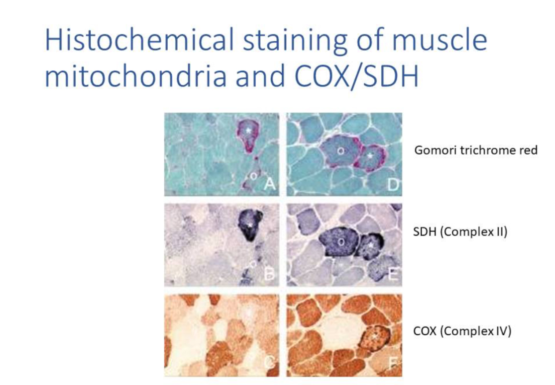 <p><span>COX-negative fibres and ragged-red/blue fibres reflect mitochondrial dysfunction.</span></p>