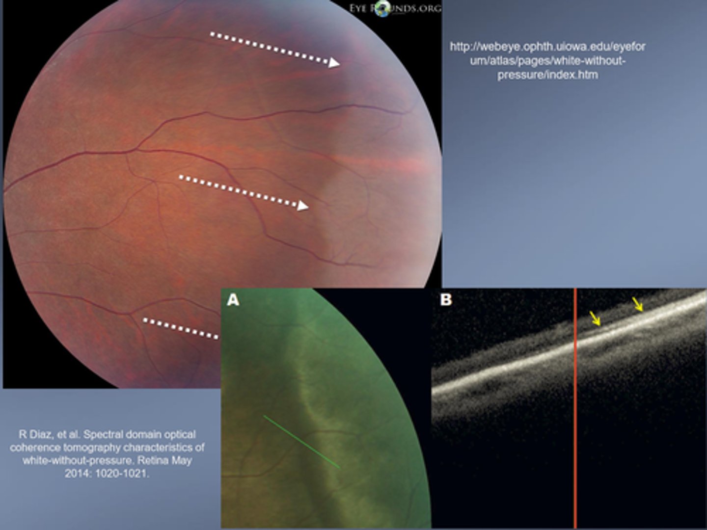 <p>prophylactic photocoagulation possible d/t small association with retinal tear</p>