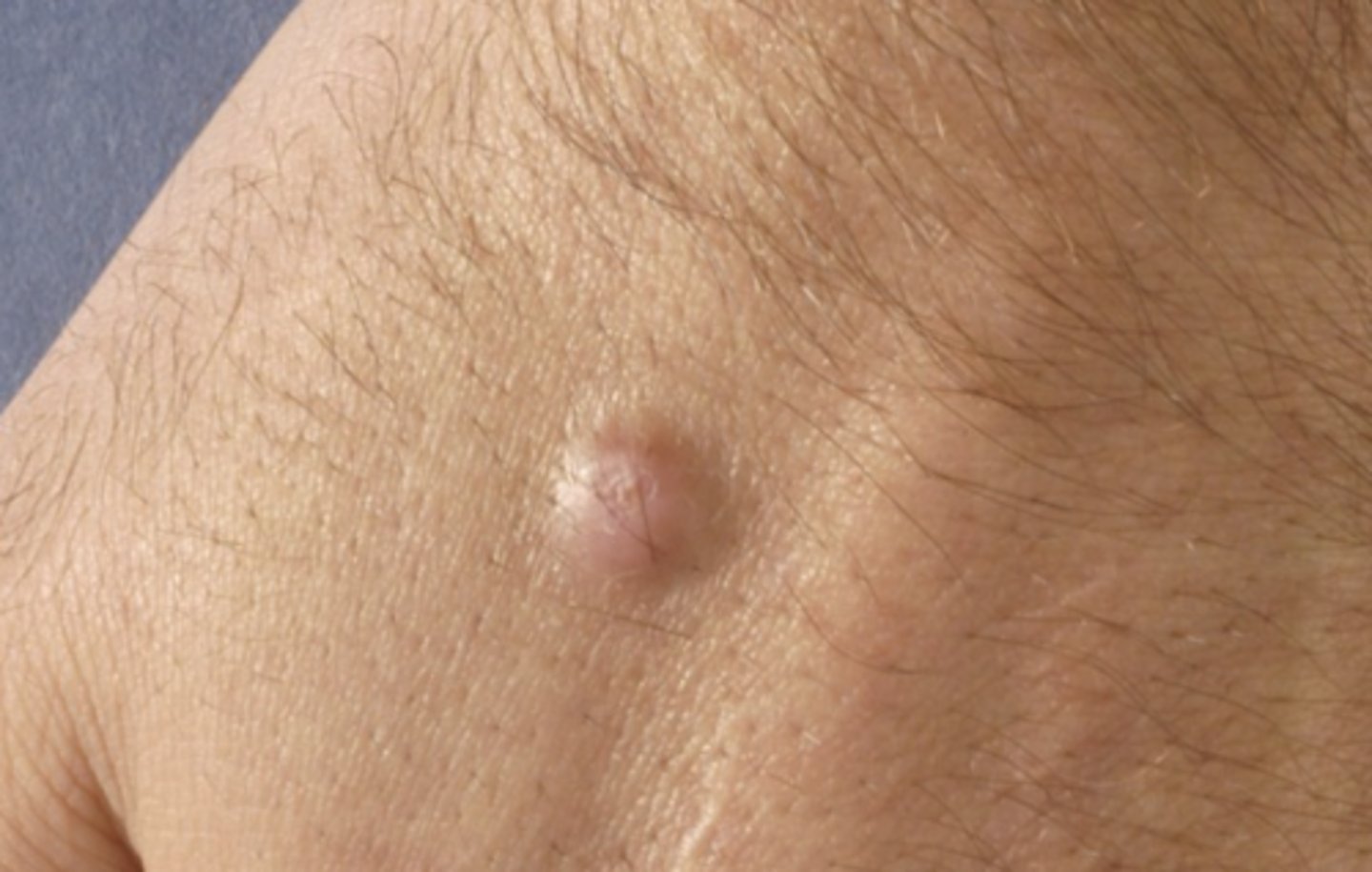 <p>= vast aanvoelende rode of gepigmenteerde nodulus</p><p>- komt vaak voor na insectenbeet</p>
