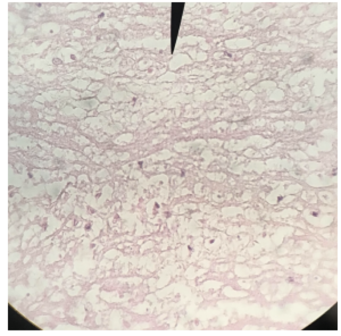 <ul><li><p>cardiac muscle been replaced by connective tissue </p></li><li><p>scar tissue doesn’t contract, can’t help the heart to pump</p></li></ul><p></p>