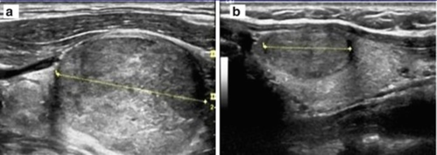 <p>Similar appearance to benign adenoma</p>