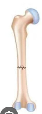 <p>occur when your bone broken perpendicular to its length <br>-usually affect longer bones from trauma accidents</p>