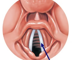 <p>inferior pair of vocal folds</p>